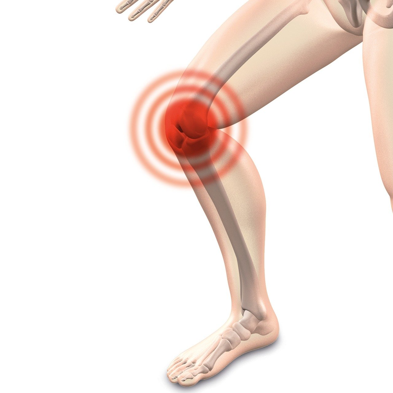Photo by naturwohl-gesundheit arthrocalman, osteoarthritis, knee